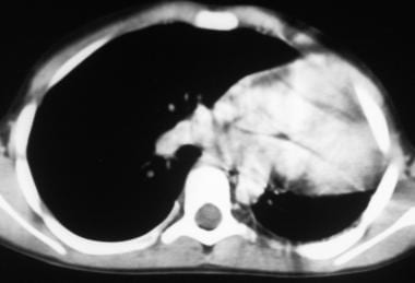 Computed tomography scan (mediastinal window) show