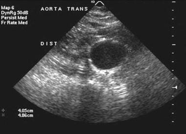 Ultrasonogram of a patient with an abdominal aorti