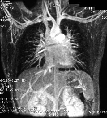 Vascular anomalies. Venous malformation (VM). Cont