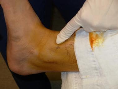 The divot between the anterior tibial tendon and t