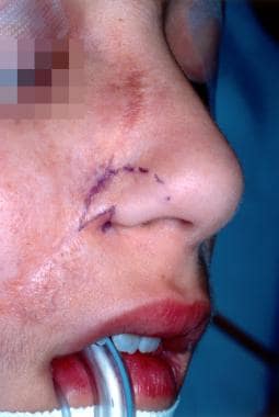 Clinical photograph of a z-plasty to reconstruct a