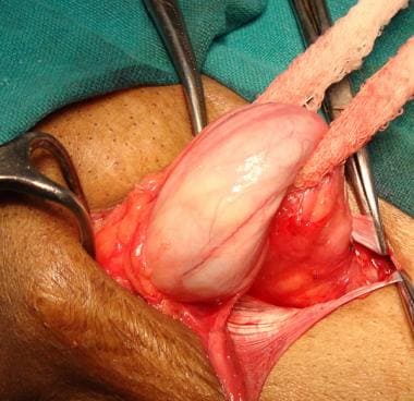 Open inguinal hernia repair. Lifting up cord with 