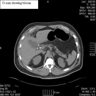 Laparoscopic cholecystectomy. CT scan illustrating