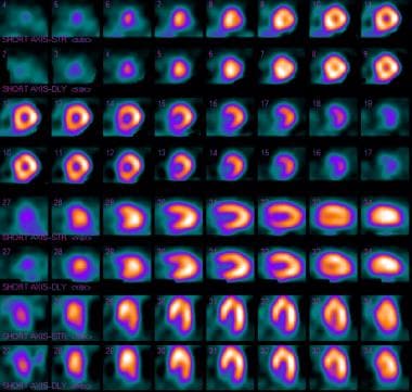 abnormal heart stress test results