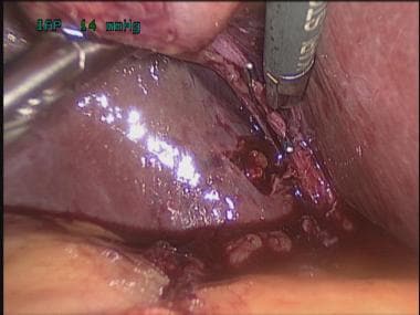 Transvaginal cholecystectomy. Division of cystic a