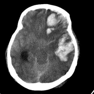 normal brain ct anatomy