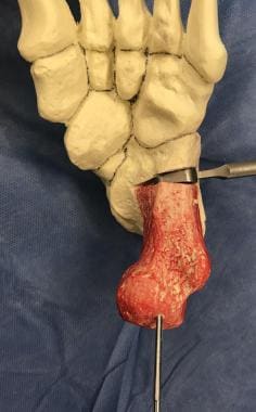 Pes planus (flatfoot). Axial model of extended Z-c