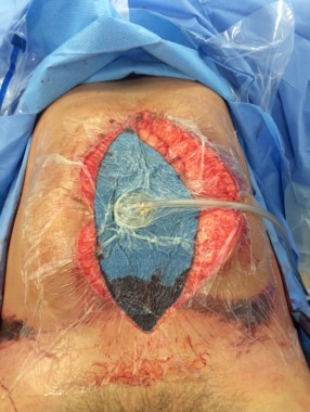 Temporary Abdominal closure after Laparotomy. Zipper System 