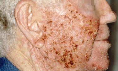 Actinic keratosis during treatment with topical 5-