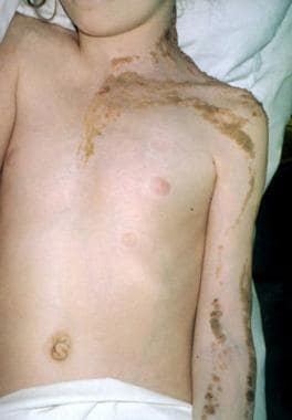 epidermal nevus