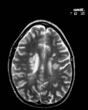 Typical adolescent multiple sclerosis findings on 