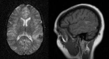 This MRI reveals petechial intracerebral hemorrhag