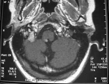 Small ependymoma in a patient with neurofibromatos