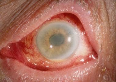 Diffuse limbus-to-limbus corneal edema and anterio