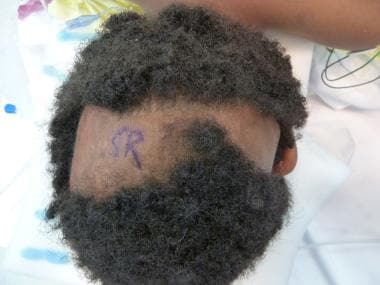Patient with significant scalp alopecia extending 