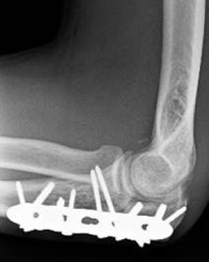Lateral radiograph of healed olecranon nonunion af