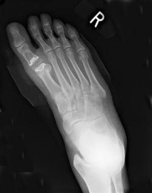 Postoperative radiograph obtained after resectiona
