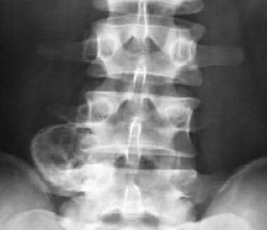 Aneurysmal bone cyst affecting the lumbar spine. C
