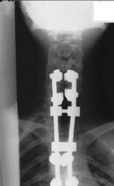 Surgical stabilization with internal fixation was 