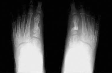 Postoperative radiograph of an 8-year-old boy with