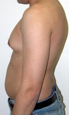 Preoperative lateral view of a patient with gyneco