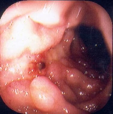 Peptic ulcer disease. Duodenal ulcer in a 65-year-