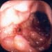 Peptic Ulcer Disease