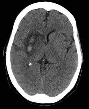 Axial noncontrast computed tomography scan of the 