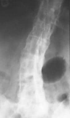 Anteroposterior radiograph of spine of a patient w
