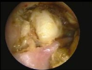 A large epitympanic (attic) cholesteatoma that is 