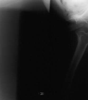 Lateral view of a displaced femoral neck fracture.