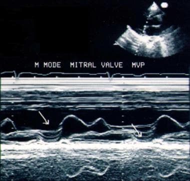 M-mode echocardiographic picture of mitral valve p