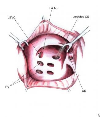 Pediatric Surgery for Unroofed Coronary Sinus. The