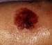 Pediatric Contact Dermatitis
