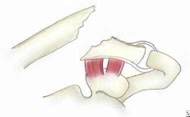 锁骨远端Ⅱ型骨折。IIA、b类