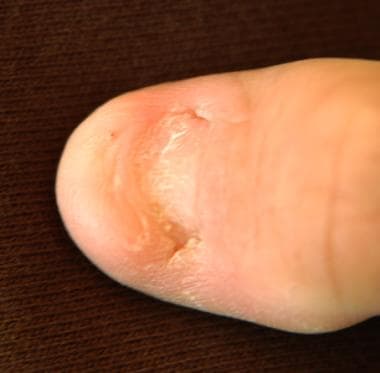 Nonsyndromic congenital nail disorder 10: MedlinePlus Genetics