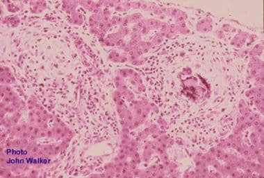 Liver granulomata secondary to Schistosoma japonic