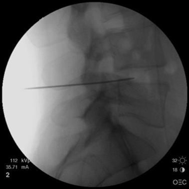 Lateral fluoroscopy view shows introducer needle i