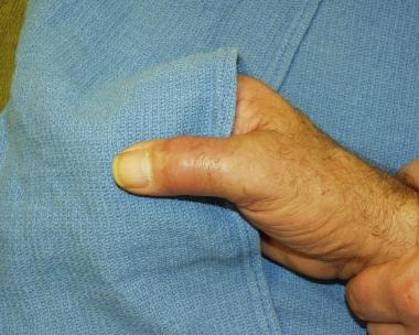 Soft Tissue Masses — What Is This Lump?: Surgical Associates of