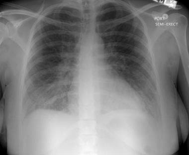 Peripartum cardiomyopathy. This radiograph reveals