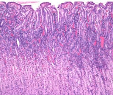 Biopsy of oxyntic mucosa from the gastric body of 