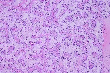 A region of clear cell renal cell carcinoma with p