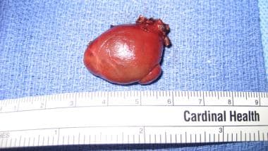Resected ectopic parathyroid adenoma from just inf