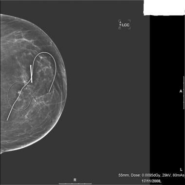 Excision biopsy of a breast lump