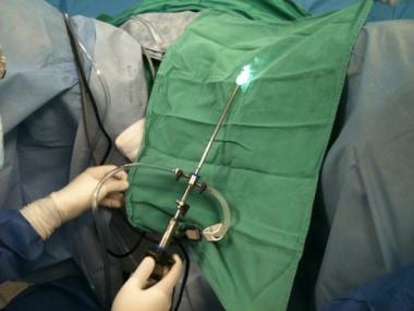Rigid 0º diagnostic hysteroscope with both inflow 
