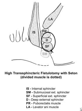 Schematic of high transsphincteric fistulotomy wit
