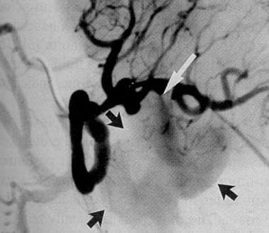 Splenic artery angiogram demonstrating contrast (w