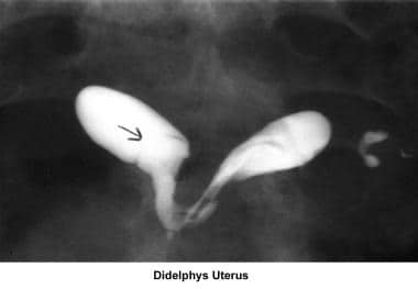 Infertility. Didelphys uterus. Image courtesy of J