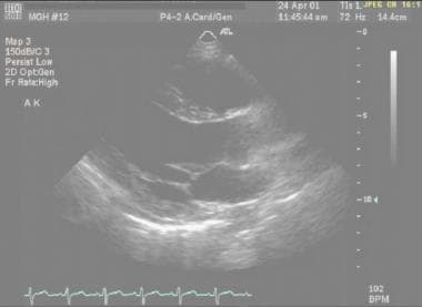 Perioperative cardiac management. The transthoraci