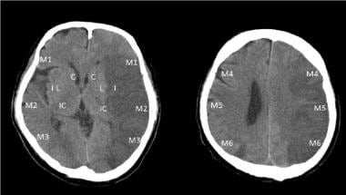 Noncontrast CT scan performed in a 60-year-old mal